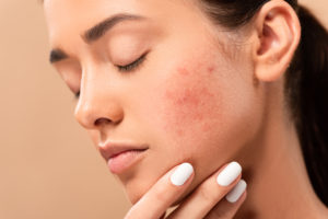 What is the Best Treatment for Acne Scars