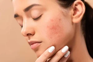 Acne Treatment by The Skin Refinery LLC in Fayetteville, TN