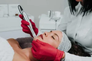 Microneedling Treatment by The Skin Refinery in Fayetteville, TN